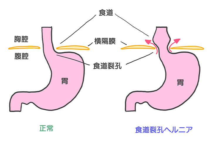 高血圧